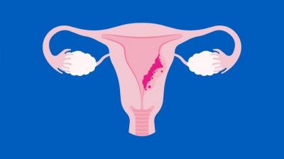 Cáncer de Endometrio